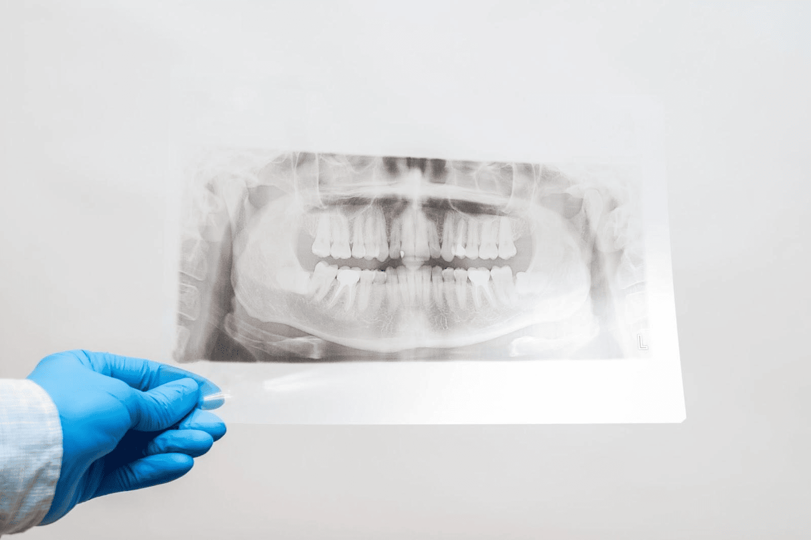 インプラントは痛い？術中や術後の痛み・痛みが出た時の対処法を解説