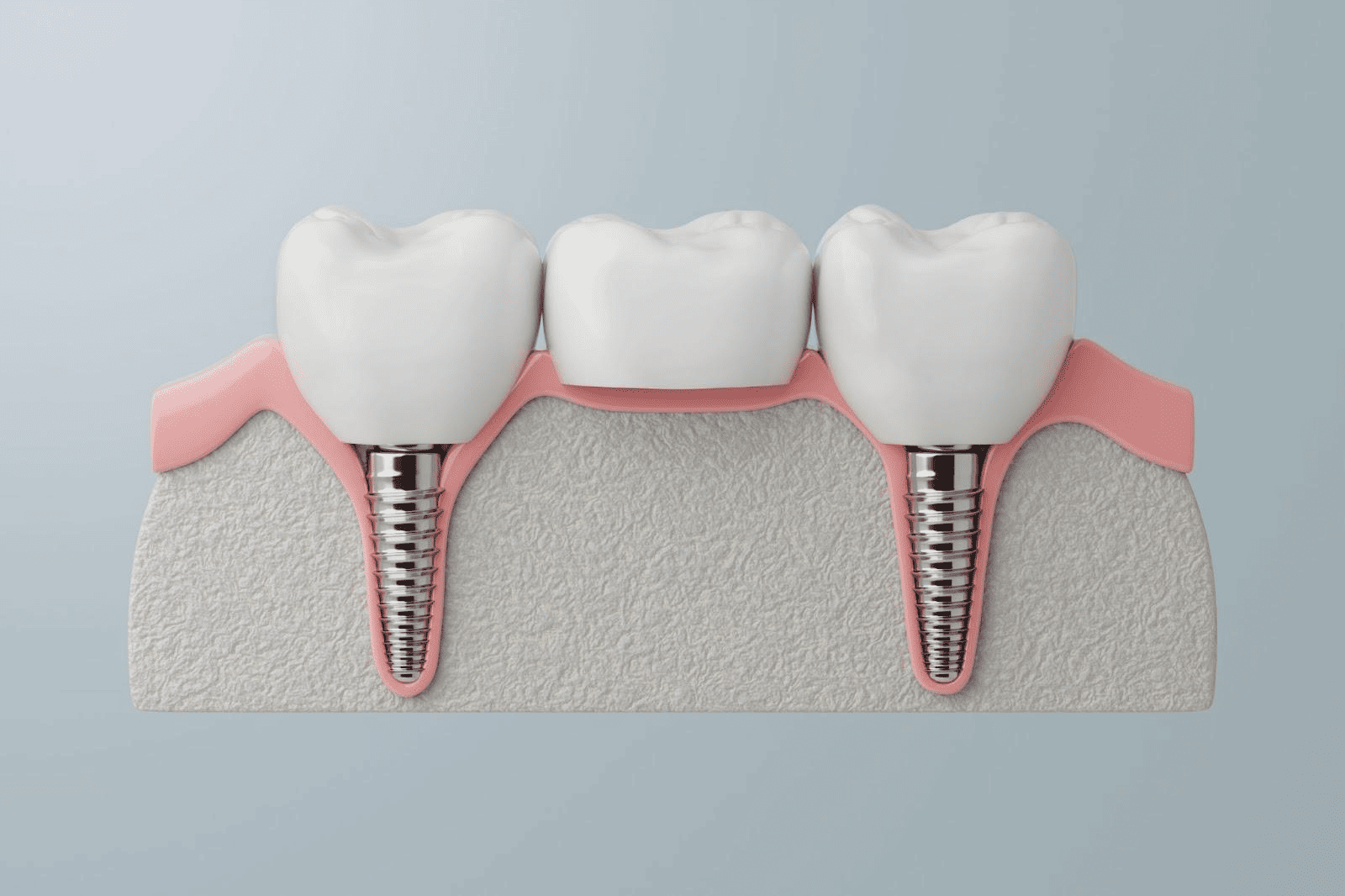 インプラント2本のブリッジの費用相場と含まれるもの